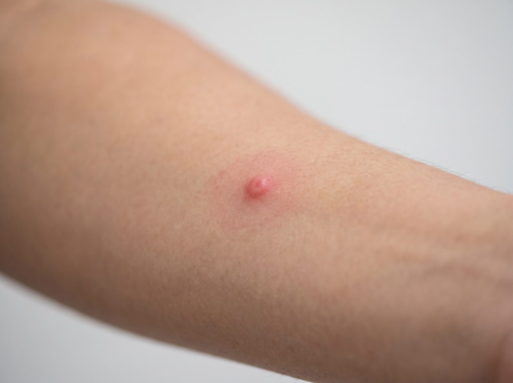 Close-up photograph of fresh grass bug bites showing clustered red welts around an ankle sock line