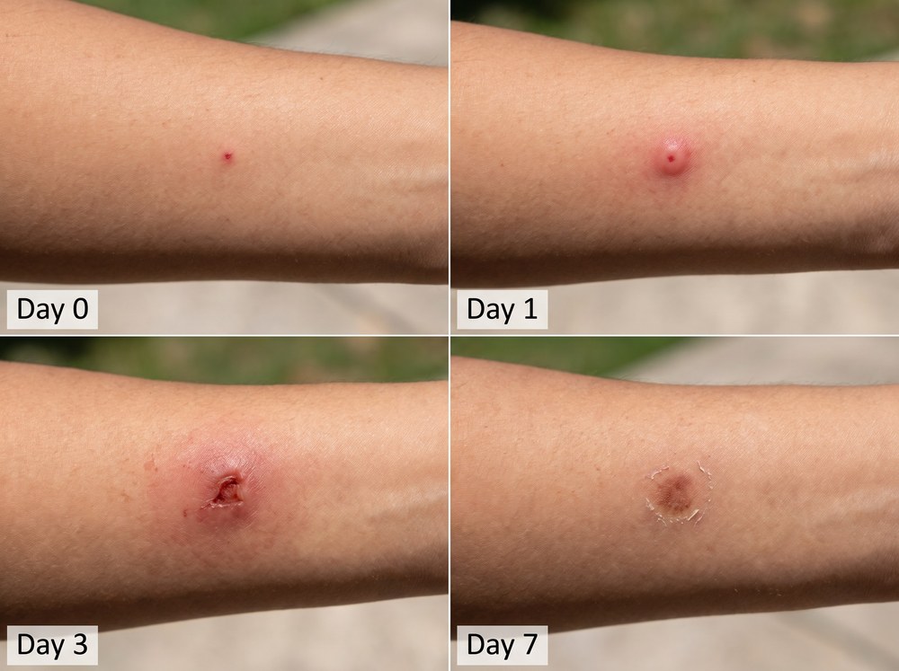 Side-by-side labeled comparison photo of grass bug chigger bites versus flea bites on skin